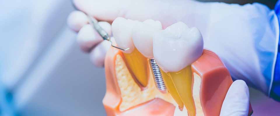 インプラントのセラミック製人工歯とは？種類や特徴を詳しく解説