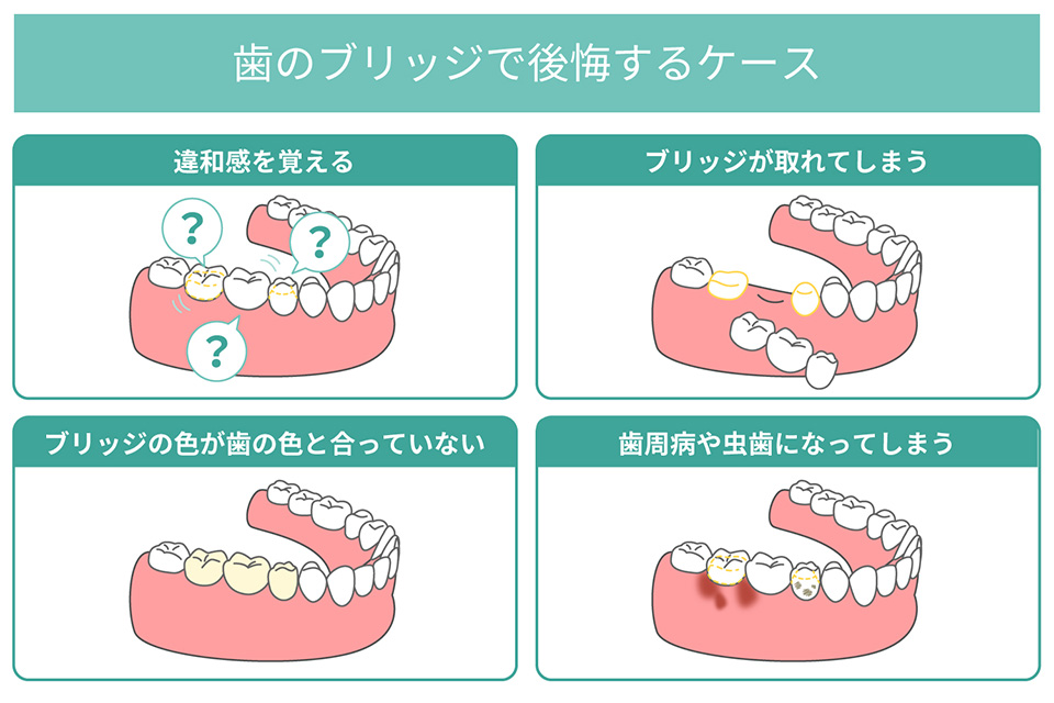 ブリッジで違和感を覚える？ 後悔するケースや対策を解説 ｜ あきもと歯科 インプラント治療専門サイト