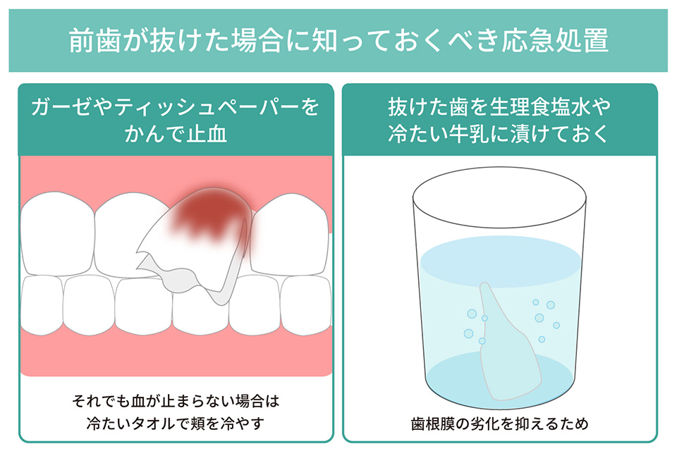 大人になって前歯が抜けたら？ 原因や対処法を解説 ｜ あきもと歯科 インプラント治療専門サイト