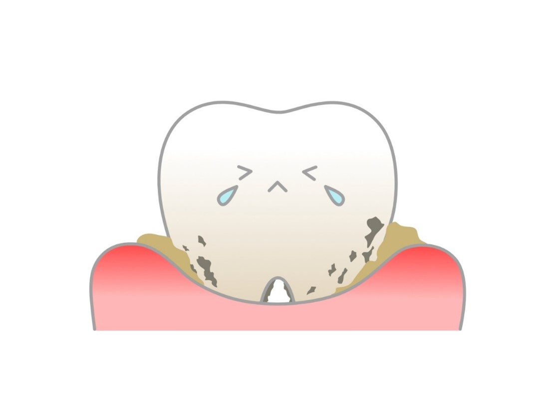 歯周病治療の費用はいくら？ステージ別の目安や治療法を解説