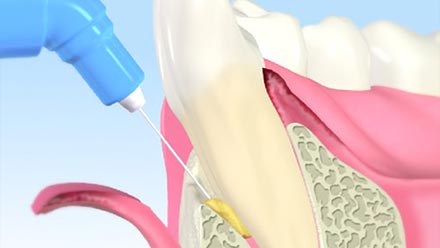 歯周病再生療法・重度歯周病治療